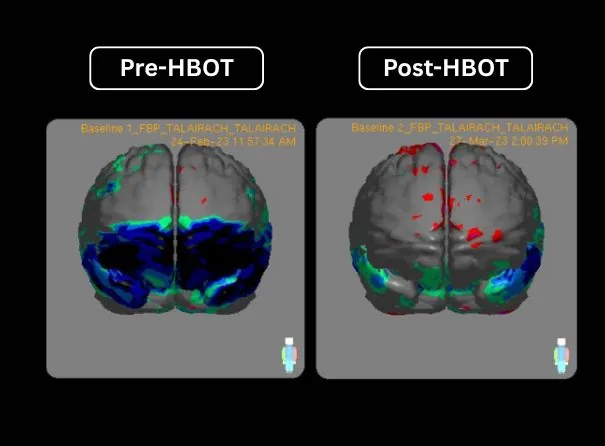 Pre-HBOT and post-HBOT SPECT scans of the same veteran
