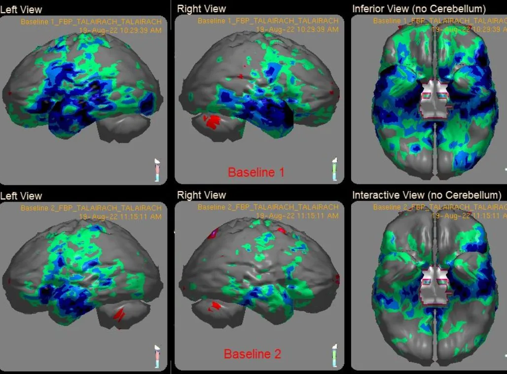 SPECT brain scan images showing blood flow in several views
